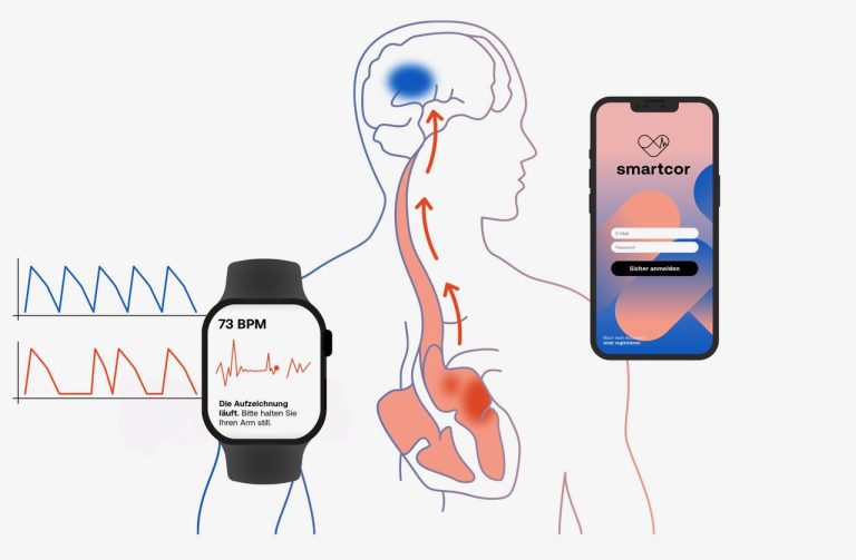 Kollage von 4 Grafiken. Von links: EKG-Aufzeichnung. EKG-Aufzeichnung auf einem Smartwatch-Display. Groß mittig ein menschlicher Körper mit grober Darstellung von der Entstehung eines Schlaganfalls, Verbindung Herz-Hirn. Zuletzt rechts der Startbildschirm der smartcor-App auf einem Handy.